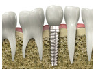 Best Ways to Manage Pain After a Root Canal in Preston